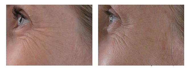 Airelle Age-Defying Eye and Lip Treatment | Anti Aging, Helps Reduce Wrinkles, Fine Lines | Dermatologist Recommended | Hyaluronic Acid, Berrimatrix | Natural Ingredients | .3 Fl Oz-GlimoraGlow