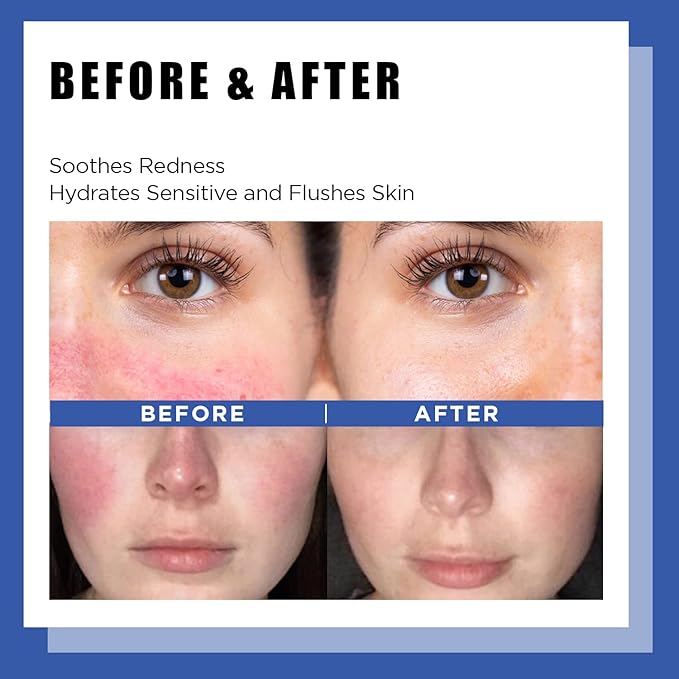 It'S SKIN LI Calming Skincare Set - Soothing Toner Pads, Ampoule Serum, Moisture Cream – Redness & Acne Relief with Licorice Extract & Guaiazulene – for Clear Skin-GlimoraGlow