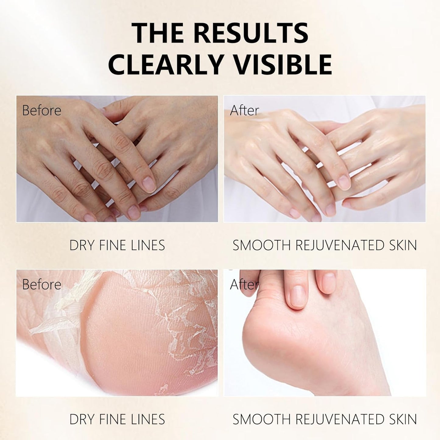 Hydrating Hand Foot Masks Set for Women Men,5 Pack Glove Mask for Dry Hand & 5 Pack Socks Mask for Dry Cracked Feet(Milk)-GlimoraGlow