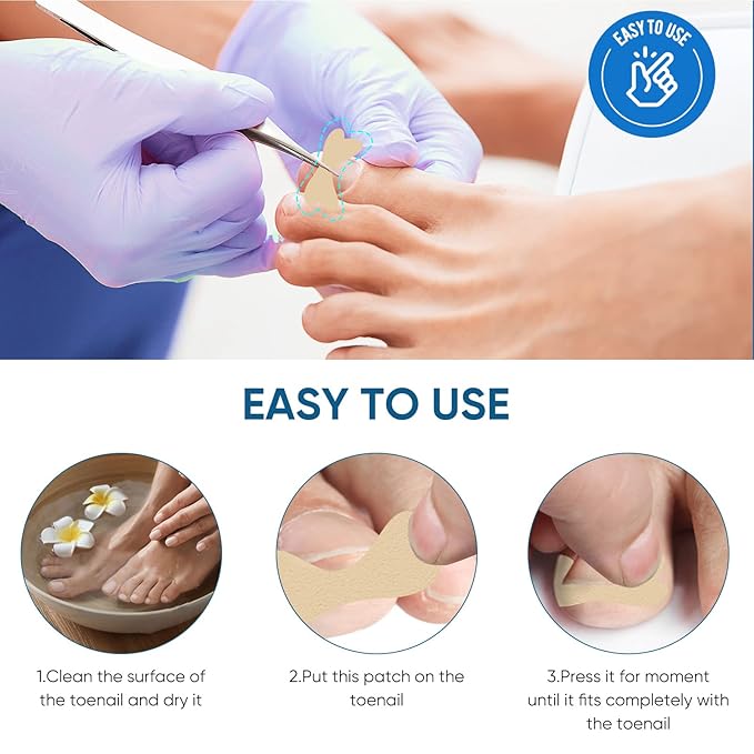Ingrown Toenail Treatment, 60Pcs Ingrown Toenail Corrector Strips, Ingrown Toenail Removal Kit with File and Lifter, 60Pcs-GlimoraGlow