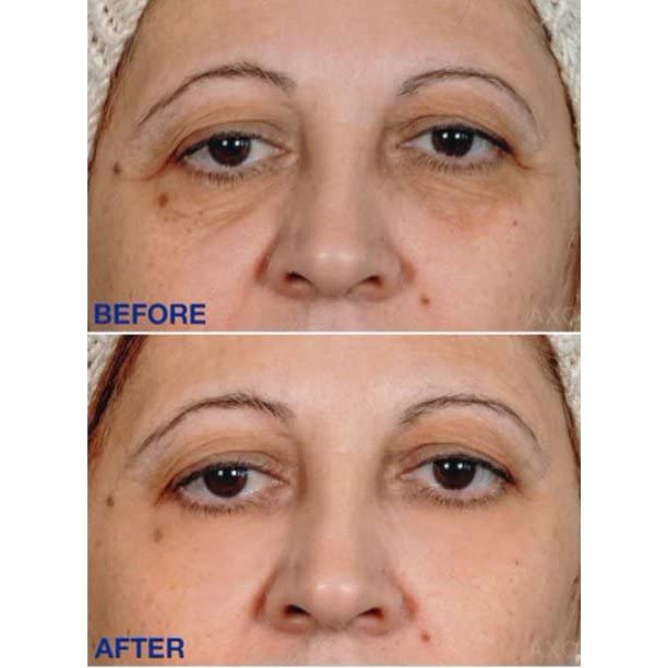 Age-Defying Under-Eye Serum | Best Instant Wrinkle Remover | Advanced Formula Anti Aging Visibly Reduces Under Eye Wrinkles, Bags, Dark Circles, Fine Lines & Crow’s Feet | 100% All-Natural-GlimoraGlow