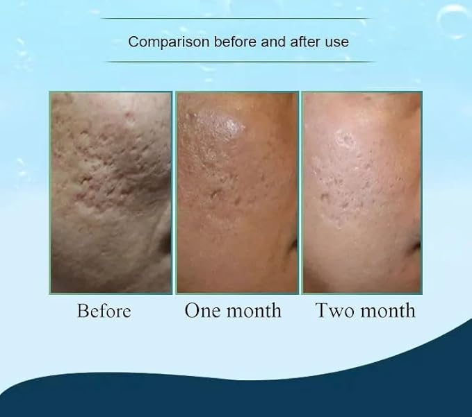 Hydra Needle 20 Titanium Serum Applicator Tools Reusable-GlimoraGlow