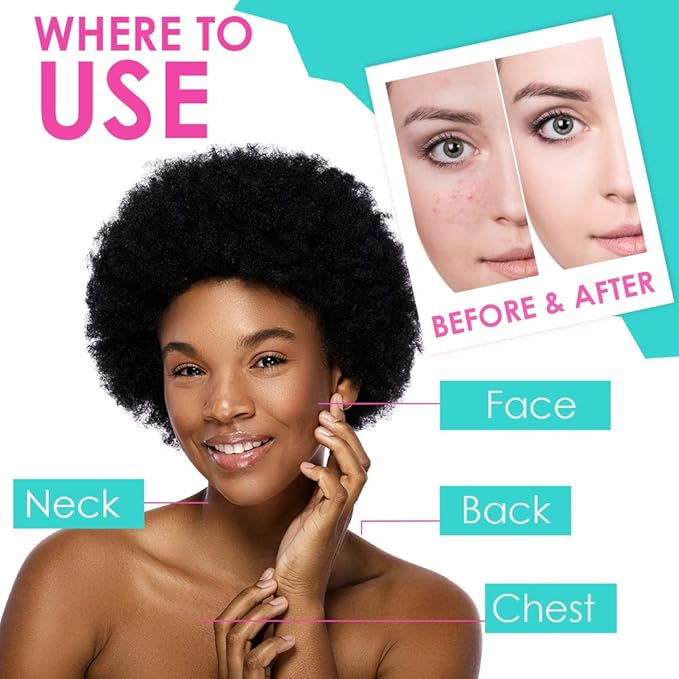 Bye Bye Blemish Acne Drying Lotion, Reduce Pimples Overnight, On-the-Spot Pimple Treatment, Beauty Skincare Essential - 1oz. (3 Pack)-GlimoraGlow