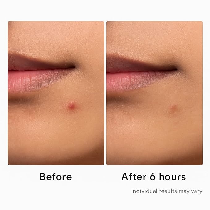 Hydrocolloid Acne Pimple Patch – 72 Count (9mm & 12mm) | Invisible Spot Patches for Pimples, Zits, Blemishes & Whiteheads | Fast Healing, Waterproof, Strong Adhesion & Gentle on Skin-GlimoraGlow