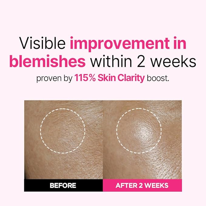 ISOI Blemish Care Up Serum for Face, Vegan Hydrating Serum for Smooth & Glass Skin Effect, Skin Barrier & Moisture Balance for Women, Korean Skin Care (0.85 fl. oz, 25ml)-GlimoraGlow