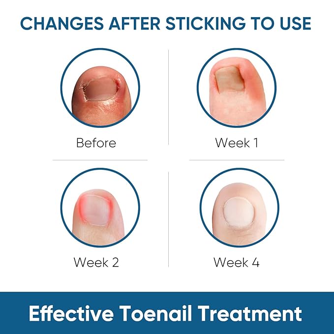 Ingrown Toenail Treatment, 60Pcs Ingrown Toenail Corrector Strips, Ingrown Toenail Removal Kit with File and Lifter, 60Pcs-GlimoraGlow