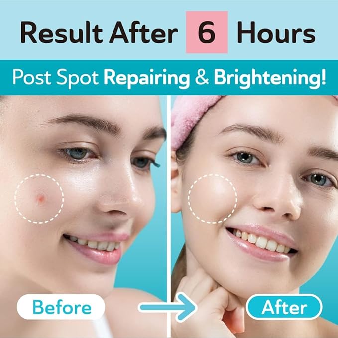 Invisible Pimple Patches for Cystic Acne - Ultra Thin Hydrocolloid Acne Patches & Zit Stickers, Cystic Acne Patch for Surface Blemishes - 48 Count - 2 Sizes Invisible Plus (Clear Patch)-GlimoraGlow