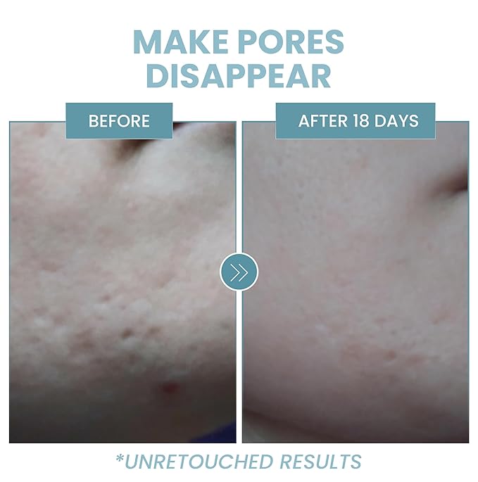 Eva Naturals Niacinamide 5% Serum for Face – B3 Pore Minimizer, Acne Treatment & Dark Spot Corrector with Hyaluronic Acid, Vitamin E, Aloe & Neem – Anti-Aging, Non-Greasy, Hydrating, 2oz-GlimoraGlow