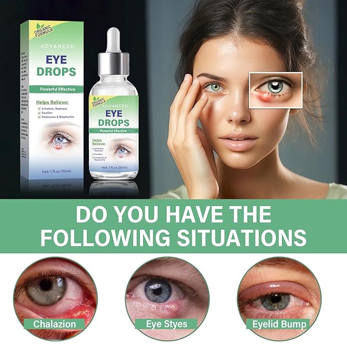 Stye Eye Treatment, Stye Eye Drops Serum for Styes Chalazion and Blepharitis, Chalazion Remover Fast Relief, Restore Healthier Eye Skin, 30ml-GlimoraGlow