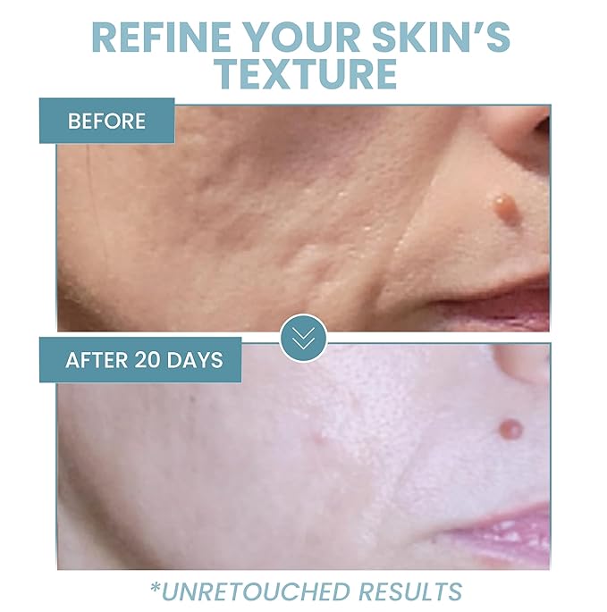 Eva Naturals Niacinamide 5% Serum for Face – B3 Pore Minimizer, Acne Treatment & Dark Spot Corrector with Hyaluronic Acid, Vitamin E, Aloe & Neem – Anti-Aging, Non-Greasy, Hydrating, 2oz-GlimoraGlow