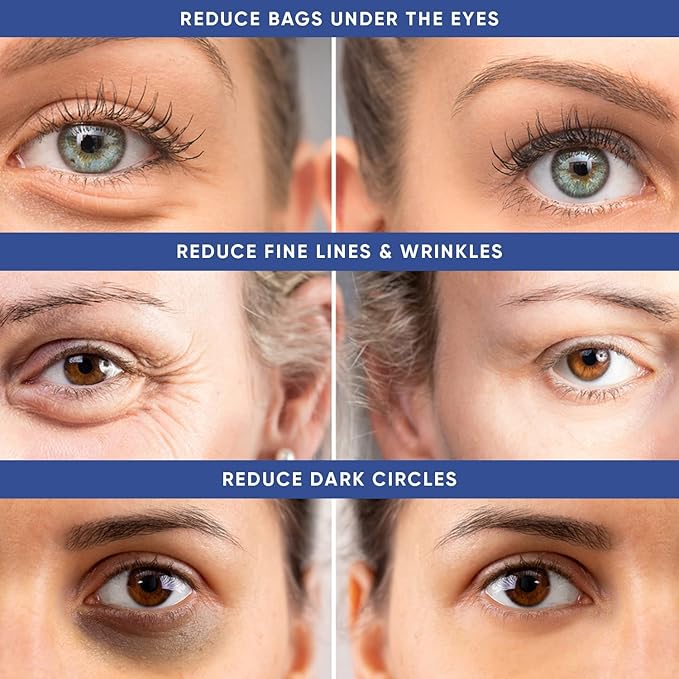 Instant Puffy Eye & Lift Treatment – Removes Under Eye Bags & Puffiness. Eliminate Dark Circles & Wrinkles. Naturally Ageless Hydrating Cream. Disappears Before Your Eyes Within Minutes.-GlimoraGlow