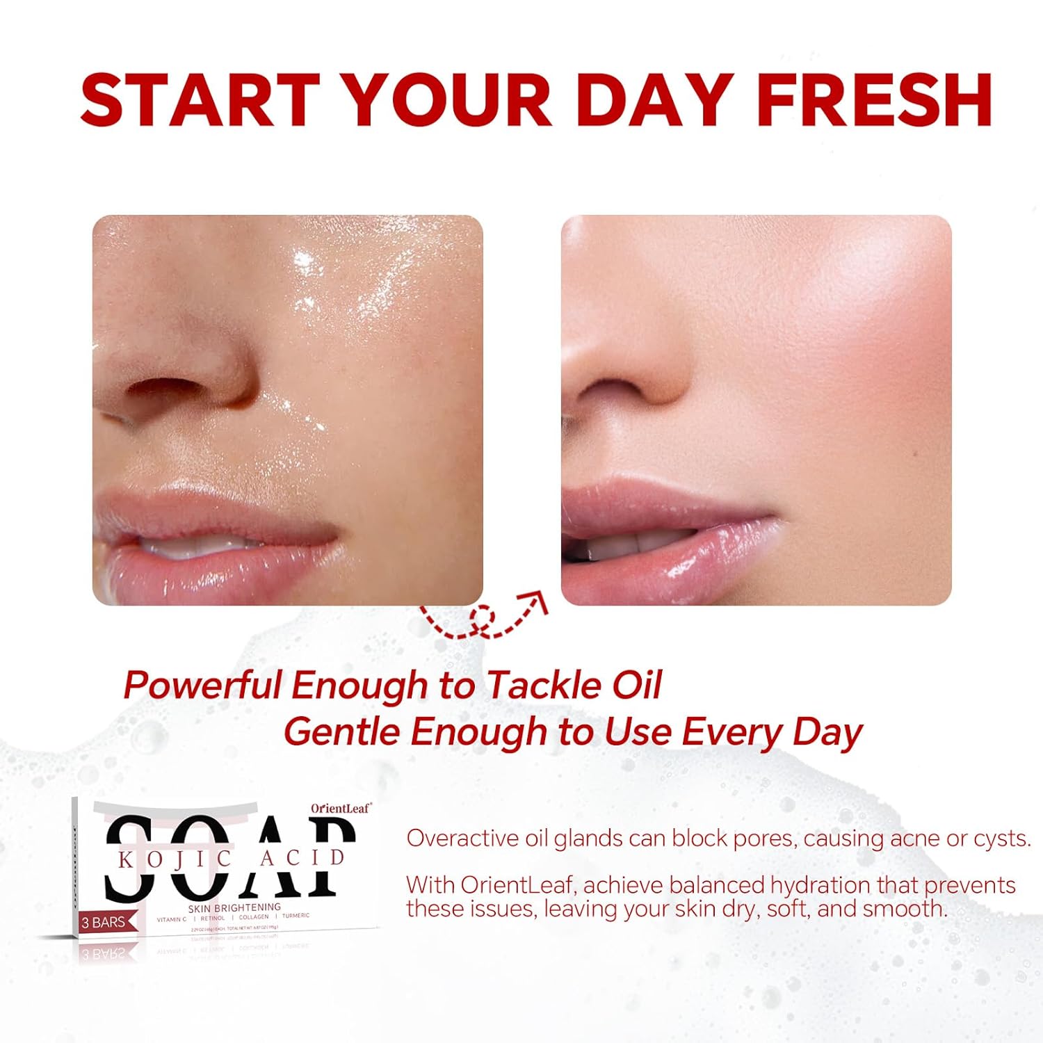 Kojic Acid Soap, Turmeric Soap Bar for Dark Spots, Fresh Citurs Scent, Gentle for Face and Body Wash with Vitamin C, Shea Butter, Retinol, Olive Oil, Collagen (3 PACK)-GlimoraGlow