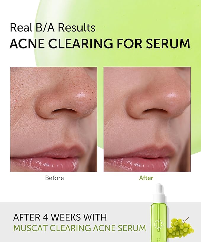 SERUMKIND Muscat Discoloration Correcting facial serum - 1fl oz - Blemishes & blackhead remover - Vegan Not Tested on Animals - Korean Skin Care - PHA Redness Relief and Exfoliating-GlimoraGlow