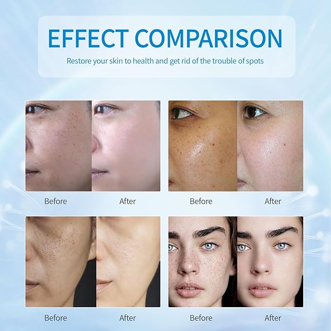 Dark Spot Remover for Face,Dark Spot Corrector, Dark Spot Serum for Sun Spots, Age Spots, Brown Spots,Acne Scars,Melasma Brown Spot -Advanced Formula with Niacinamide Retinol for Women (1.0 Fl Oz)-GlimoraGlow