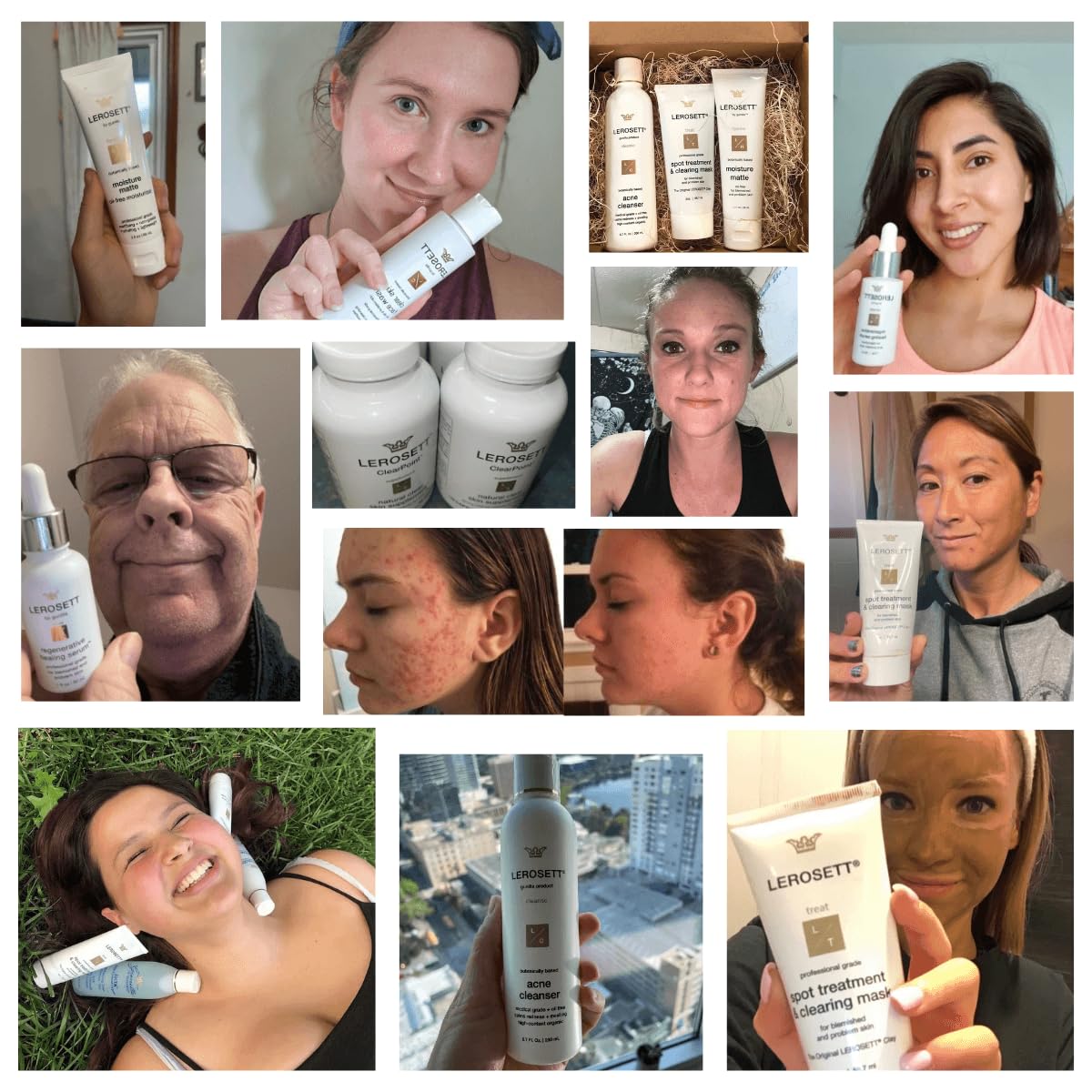 LEROSETT Serum for Acne Scarring Healing, Pimples, Redness, Breakouts, Blemishes, Hydrate & Soothes Irritated Skin, Natural Serum. Spa-Grade, Plant Based, Concentrated - 1 oz-GlimoraGlow