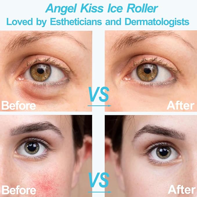 Angel Kiss Ice Roller for Face Eye, Women Gift Idea, Cold Therapy Massager for Reduce Puffiness, Redness, Dark Circles, Tightening Firming, Reduce Wrinkles, Migraine Pain Relief, w/Premium Carry Case-GlimoraGlow