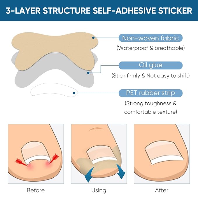 Ingrown Toenail Treatment, 60Pcs Ingrown Toenail Corrector Strips, Ingrown Toenail Removal Kit with File and Lifter, 60Pcs-GlimoraGlow
