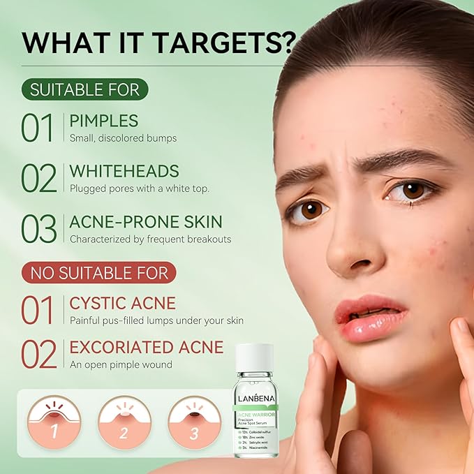 LANBENA Precision Acne Spot Serum, Acne Drying Lotion, Overnight Acne Treatment For Face, Dry Out Pimples, Blemishes, Zits And Clean Pores, 0.42 Fl Oz-GlimoraGlow