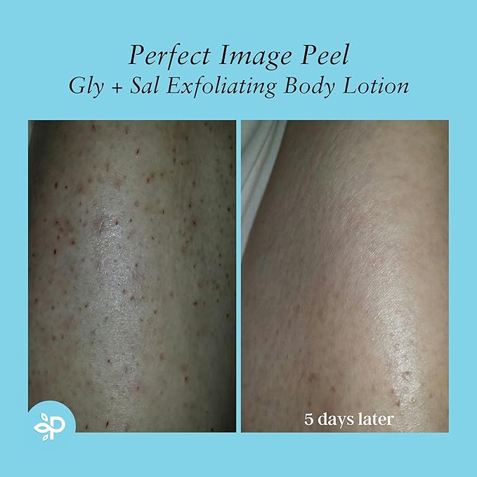 Perfect Image Gly + Sal Exfoliating Body Lotion, 8% Glycolic Acid and 2% Salicylic Acid Lotion Enhanced with Green Tea, Papaya, Bearberry, Licorice and Amino Complex-GlimoraGlow