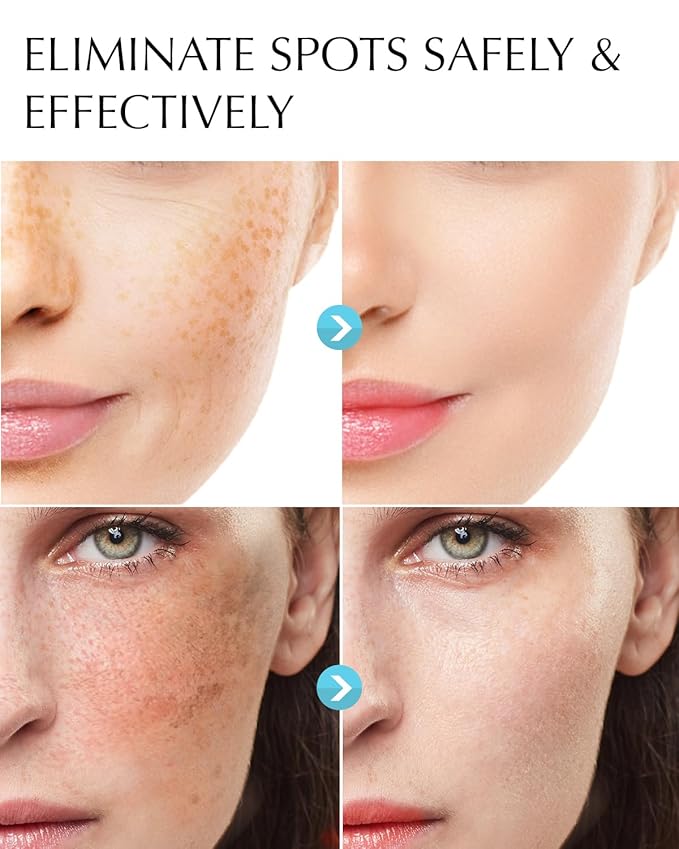 Dark Spot Remover for Face and Body: Hyperpigmentation Treatment - Natural Ingredient - Freckle/Melasma/Sun Spot/Age Spot Remover - Dark Spot Corrector Cream for Women and Men-GlimoraGlow