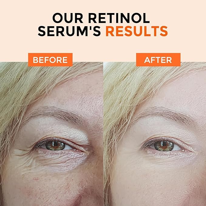 Retinol Serum for Face 2.5%, B5 Herbal Resurfacing Retinol with Vitamin C, Vitamin E, Hyaluronic Acid, Anti-Aging, Wrinkle Smoothing, Dark Spot Corrector, Brighten Dullness 2 Packs-GlimoraGlow