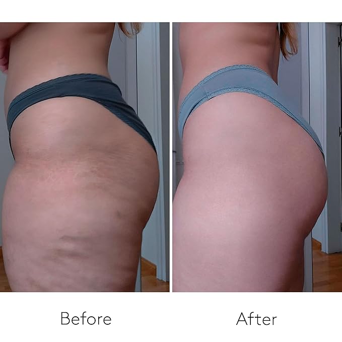 COCUNAT - Body Power - Anti Cellulite Cream - Body Firming Cream - Cellulite Remover - Toned Skin - With Caffeine and Hyaluronic Acid - 150 ml + 125 ml-GlimoraGlow