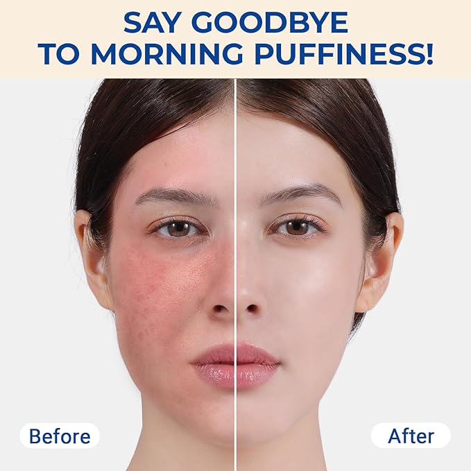 MORGLES Ice Roller for Face and Eyes, Ice Face Roller for Women Skin Care, Cold Facial Roller for Puffiness, Migraine Relief and Lymphatic Drainage-GlimoraGlow