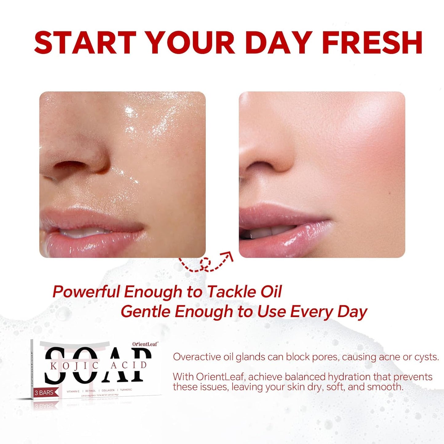 Kojic Acid Soap, Turmeric Soap Bar for Dark Spots, Fresh Citurs Scent, Gentle for Face and Body Wash with Vitamin C, Shea Butter, Retinol, Olive Oil, Collagen (3 PACK)-GlimoraGlow