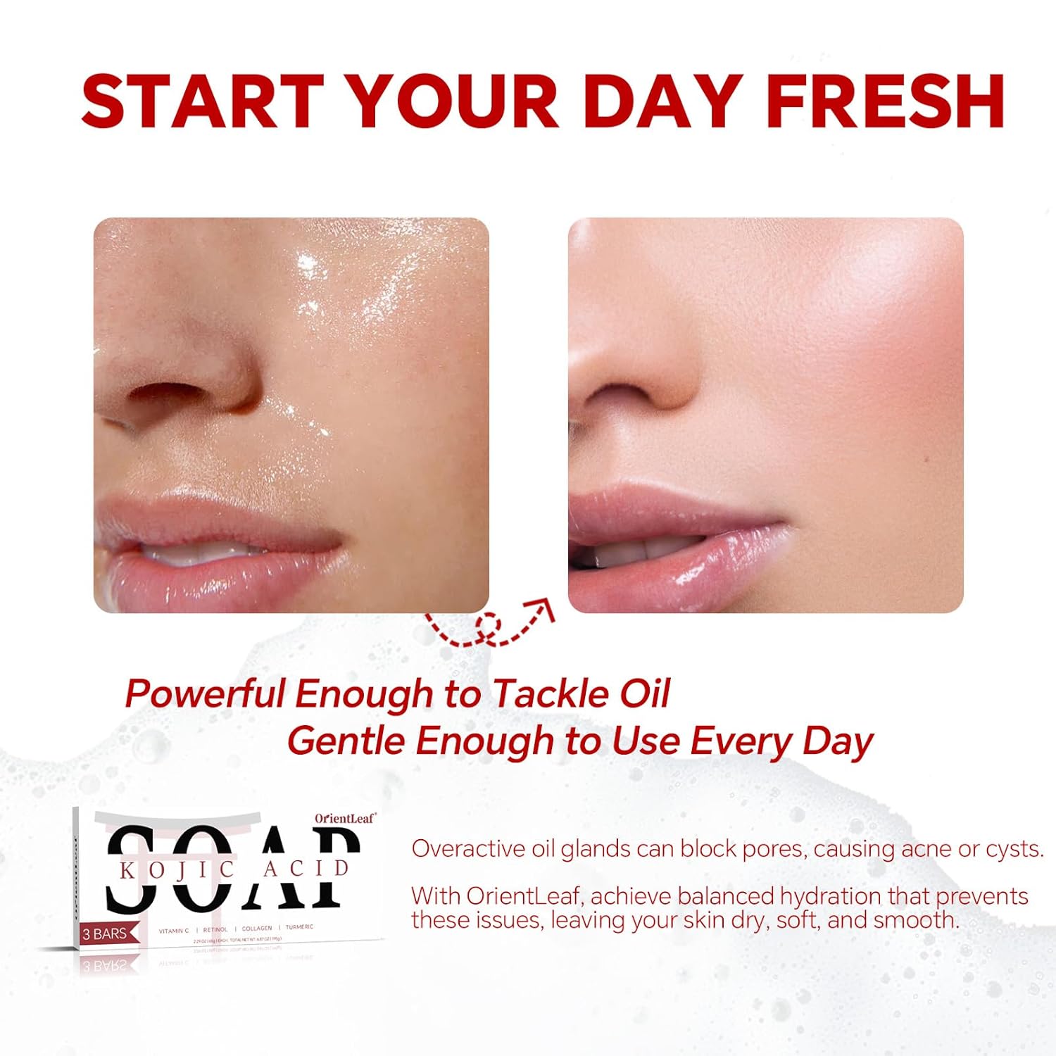 Kojic Acid Soap, Turmeric Soap Bar for Dark Spots, Fresh Citurs Scent, Gentle for Face and Body Wash with Vitamin C, Shea Butter, Retinol, Olive Oil, Collagen (3 PACK)-GlimoraGlow