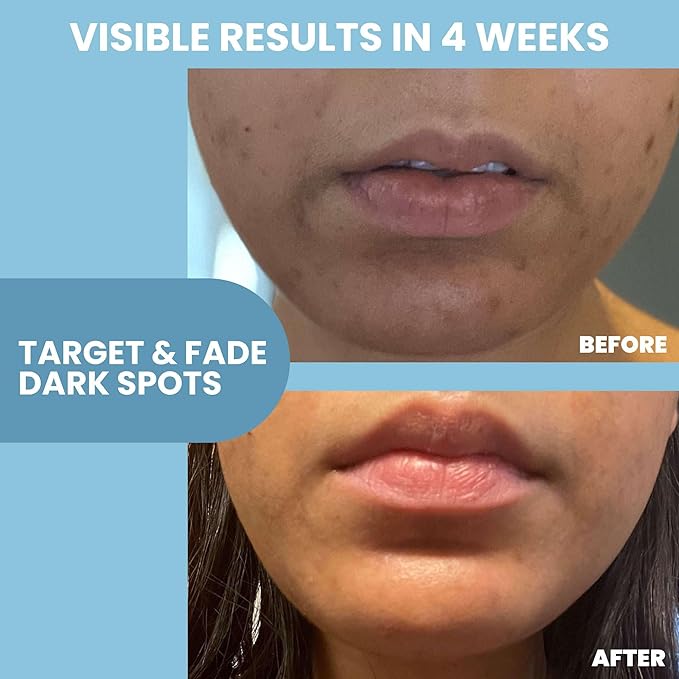 Eva Naturals Niacinamide 12% + Zinc Serum for Face – Dark Spot Remover, Pore Minimizer, Redness Relief, Hydrating Vitamin B3 with Botanical Hyaluronic Acid, Anti-Aging Serum for Clear Skin (2 Pack)-GlimoraGlow