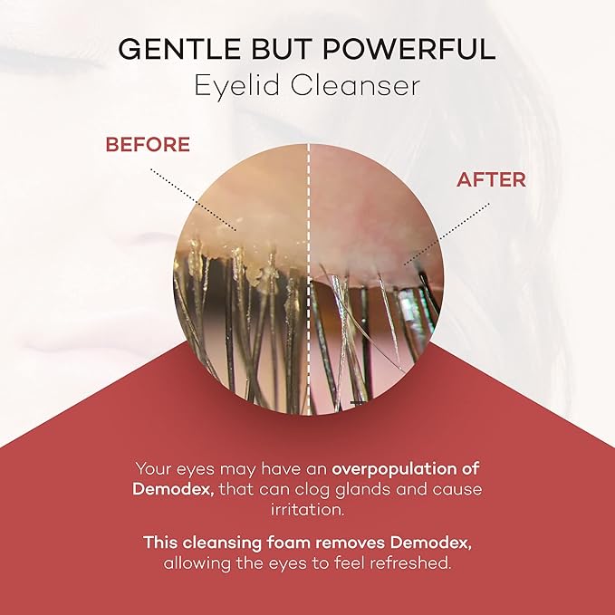 ZocuFoam Eyelid Cleanser - Foaming Eyelid Scrub - Natural pH Balanced Solution - 1.7 FL OZ (50mL)-GlimoraGlow