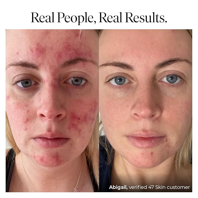 | Hydrating Face Serum with Silver Chitoderm for ALL Skin Types | Clears Acne, Prevents & Heals Breakouts & Blemishes, Repairs Scars | Moisturises and Nourishes For Smooth Skin | 30ml-GlimoraGlow