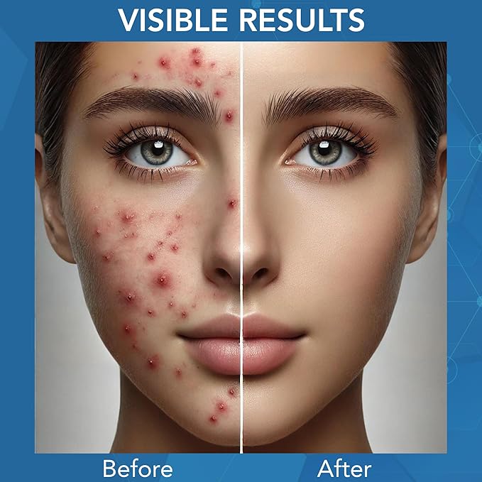 NOVEHA Facial Cleanser For Acne - Hypochlorous Acid Spray - Irritation, Redness & Breakouts Relief - Ideal for Active Teenage & Adult Athletes Post-Workout - Safe for Multiple Daily Uses - 8 oz-GlimoraGlow