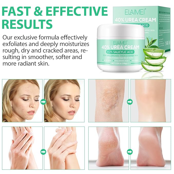 J&H Jasmine&Hyacinth 40% Urea Cream with 2% Salicylic Acid, Aloe, Feet/Heel Cream Moisturizer for Dry Cracked Heel, Knees, Elbows, Hands, Callus Remover, Intensive Hydrating Treatment-5.3 OZ/150 G-GlimoraGlow