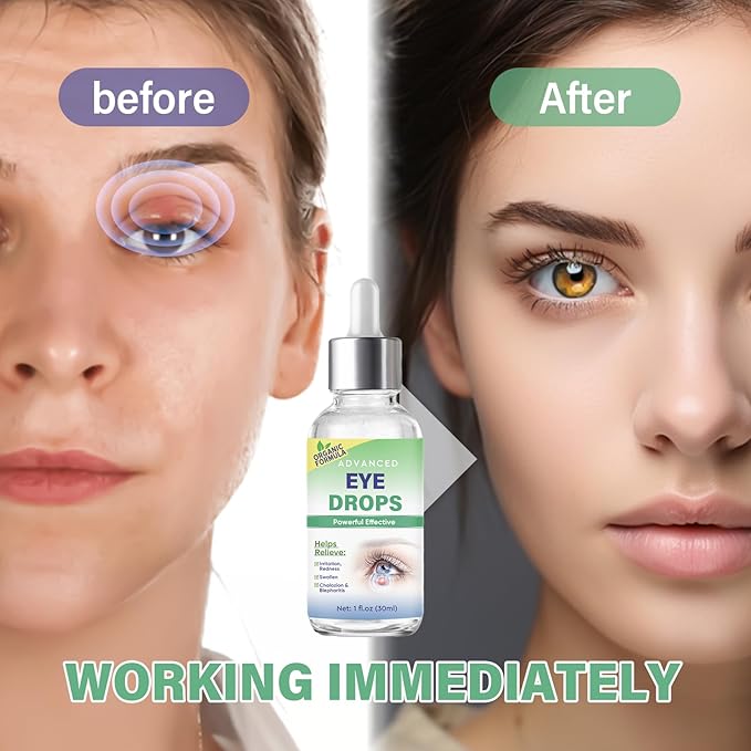 Stye Eye Treatment, Stye Eye Drops Serum for Styes Chalazion and Blepharitis, Chalazion Remover Fast Relief, Restore Healthier Eye Skin, 30ml-GlimoraGlow