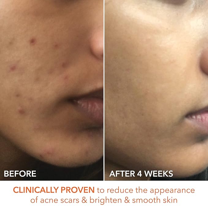 Dr. Dennis Gross Alpha Beta Extra Strength Daily Peel: for Oily Skin, Uneven Tone or Texture, Wrinkles or Enlarged Pores (30 Treatments)-GlimoraGlow