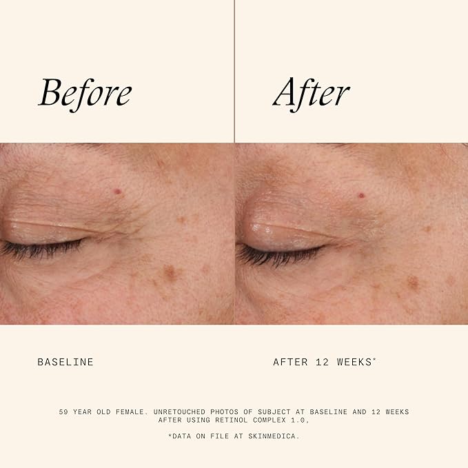 SkinMedica Retinol 1.0 Complex - Retinol Serum for Face, Age-Defying Advanced Retinol Cream That Renews Skin and Diminishes the Appearance of Fine Lines and Wrinkles, 1 Fl Oz-GlimoraGlow