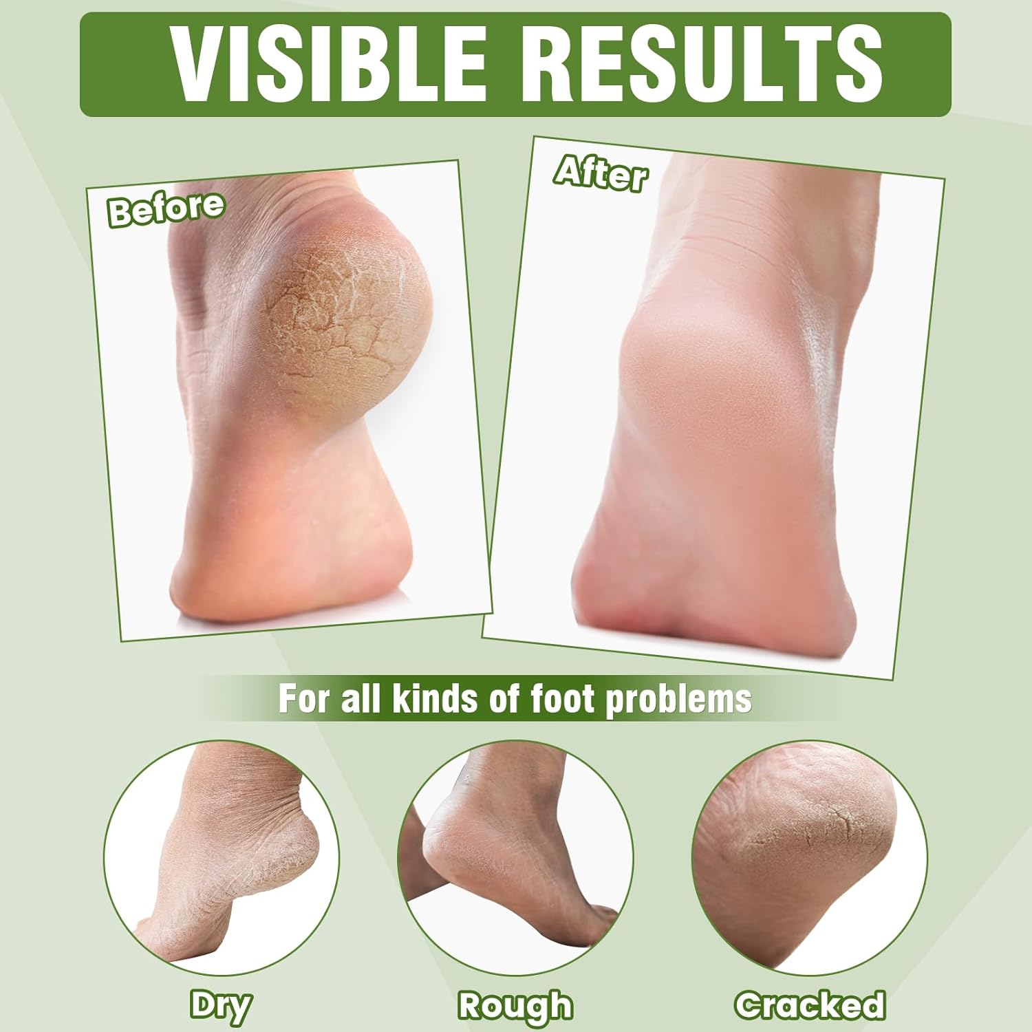 18 Pairs Moisturizing Foot Masks with Shea Butter, Jojoba Oil, Vitamin E & Urea, Intensely Hydrating Foot Mask For Dry Cracked Feet, Moisturizing Socks for Cracked Heel Treatment-GlimoraGlow