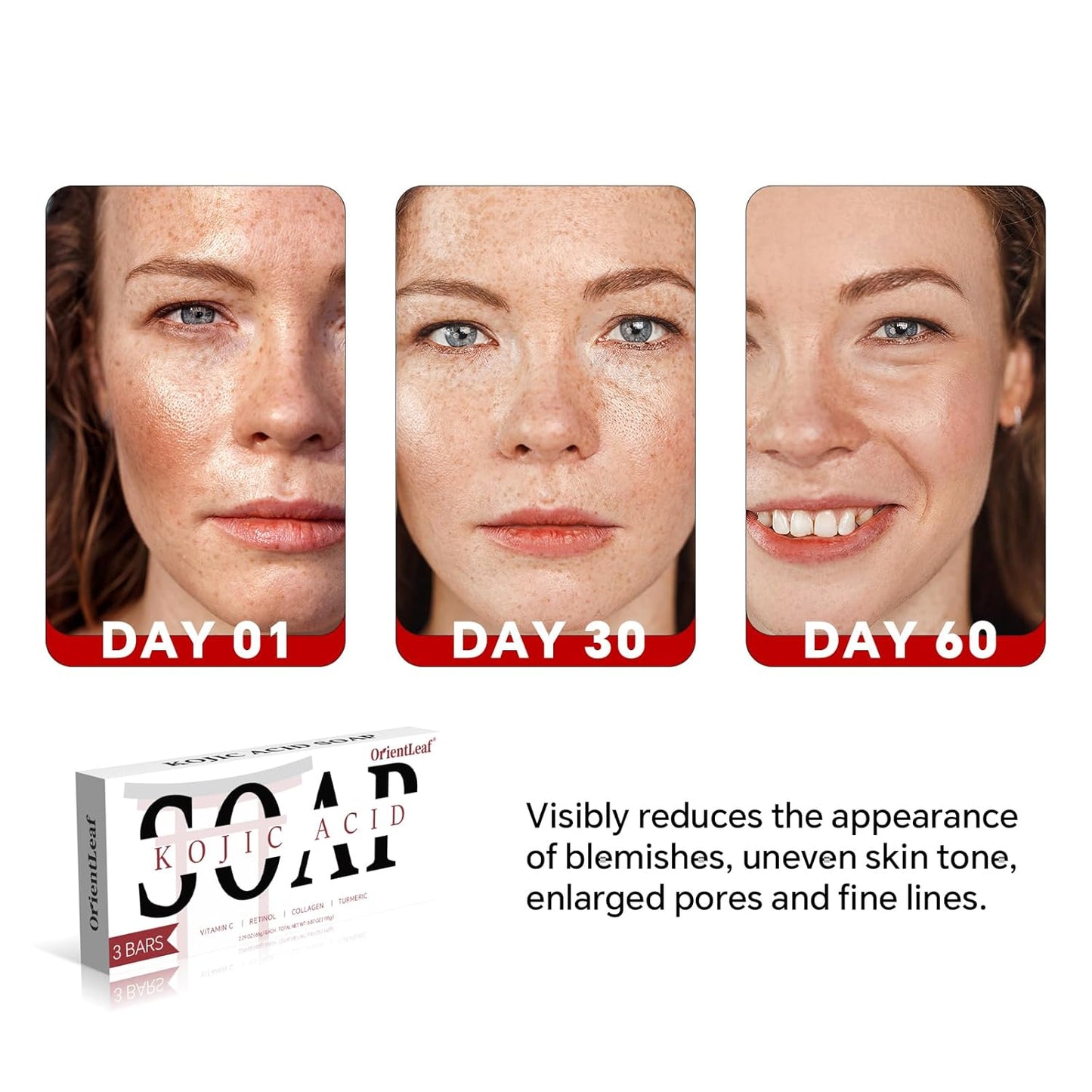 Kojic Acid Soap, Turmeric Soap Bar for Dark Spots, Fresh Citurs Scent, Gentle for Face and Body Wash with Vitamin C, Shea Butter, Retinol, Olive Oil, Collagen (3 PACK)-GlimoraGlow