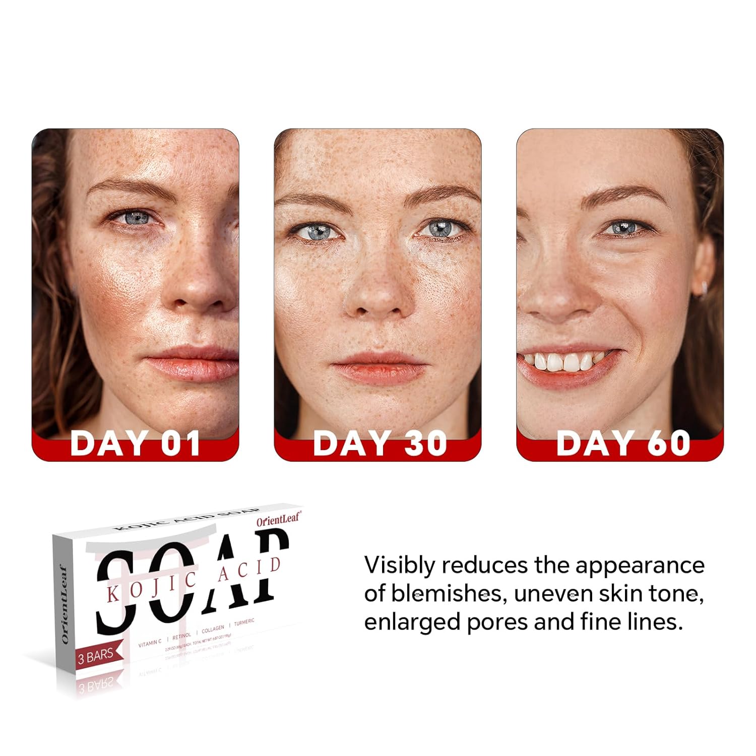 Kojic Acid Soap, Turmeric Soap Bar for Dark Spots, Fresh Citurs Scent, Gentle for Face and Body Wash with Vitamin C, Shea Butter, Retinol, Olive Oil, Collagen (3 PACK)-GlimoraGlow