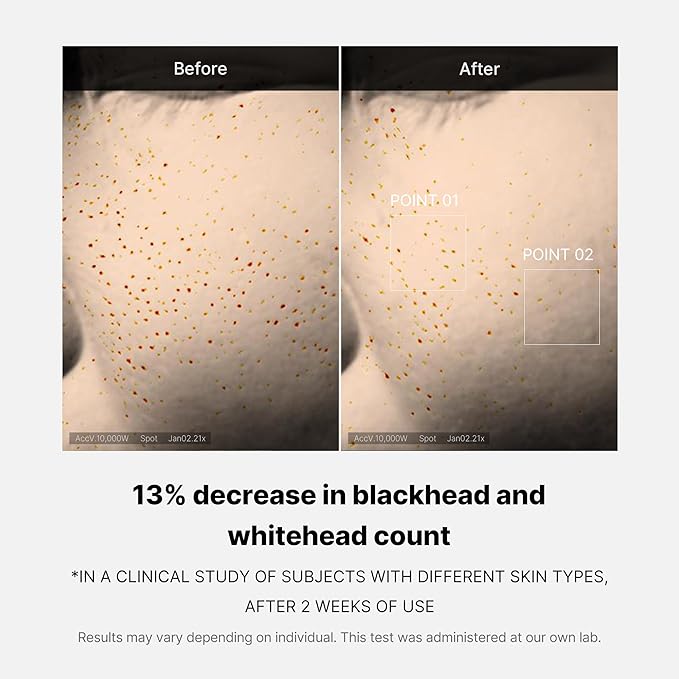 Medicube Zero Pore One-day Serum 1.01 fl.oz - Overnight Resurfacing Serum with Pore Tightening Complex - 15.2% AHA+BHA+PHA & 2% Niacinamide - 10.8% reduction in pore appearance after one day of use-GlimoraGlow