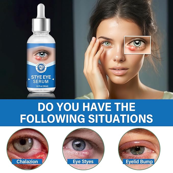 Stye Eye Treatment, Stye Eye Serum for Styes Chalazion and Blepharitis, Gently Cleanses Lashes and Eyes, Restore Healthier Eye Skin, 1 Fl.oz-GlimoraGlow