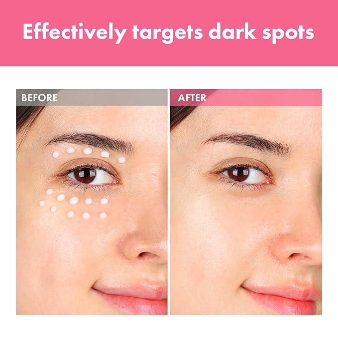 Arbutin 7% Intensive Spot Cream with 70,000ppm Arbutin, 3% Tranexamic Acid, 1% Niacinamide, Glutathione, Dark Spots, freckle, Blemishes, Anti-pigmentation, Korean Skin Care, 20ml, 0.67 fl.oz-GlimoraGlow