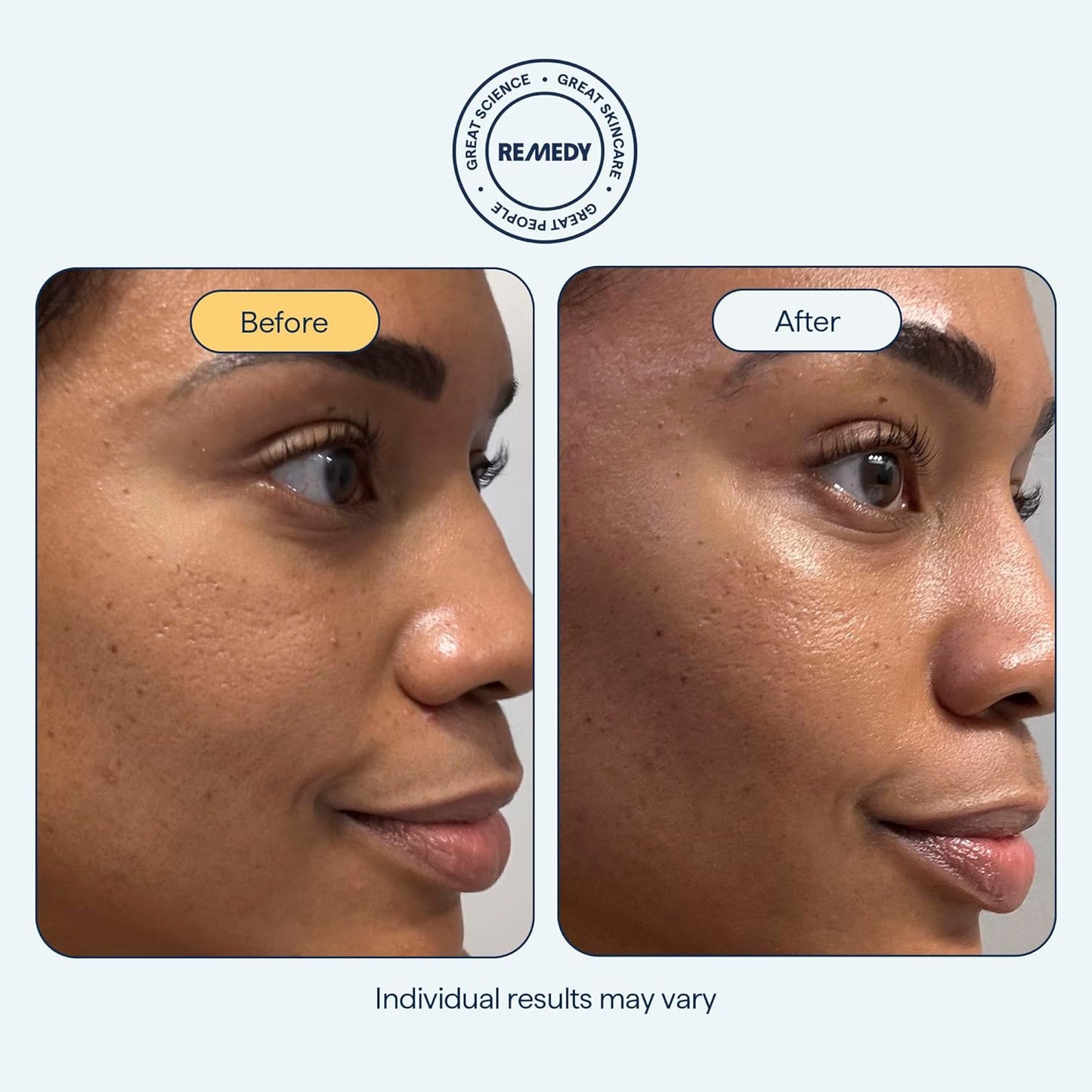 Remedy for Rich Moisture - Barrier Repairing Rich Cream Moisturizer for Normal to Dry Skin - Quadruple Ceramide Complex, Peptides, Squalane, Glycerin- By Dermatologist Dr. Shah, 1.7 fl. oz-GlimoraGlow