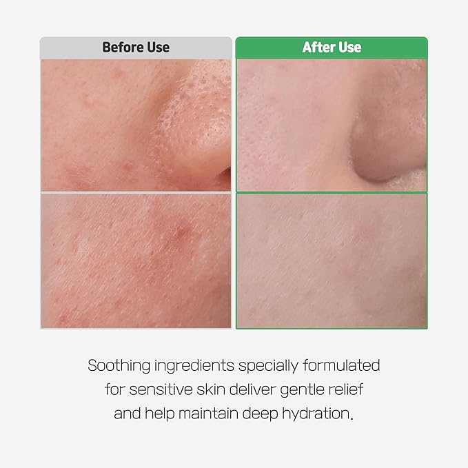 Cica Bio Spot Control Patch (1 Box, 62pcs) | Soothing Acne Patch for Redness & Blemishes | With Cica, Niacinamide & Tea Tree | Gentle for Sensitive Skin | Korean Skincare-GlimoraGlow