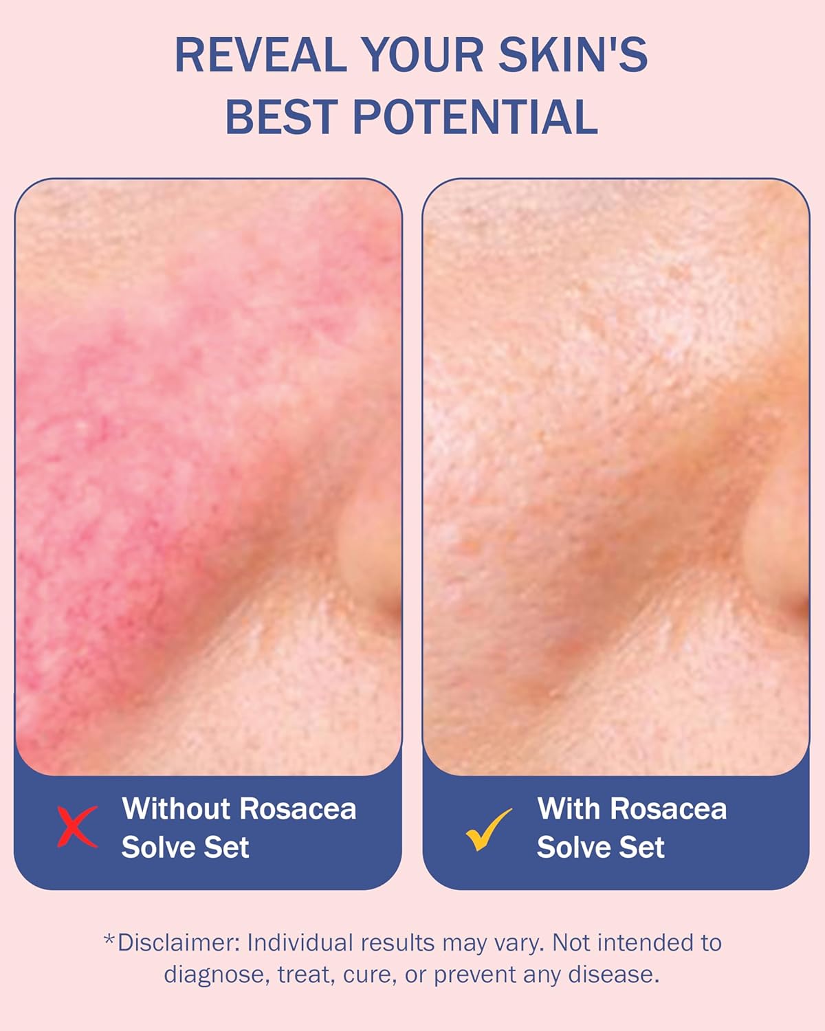 Rosacea Treatment Skincare for Women & Men - Face Wash, Rosacea Cream & Face Serum, Moisturizer Redness Reducing Skin Care with Aloe Vera, Hyaluronic Acid & Fruit Extracts, Made in USA by e70-GlimoraGlow