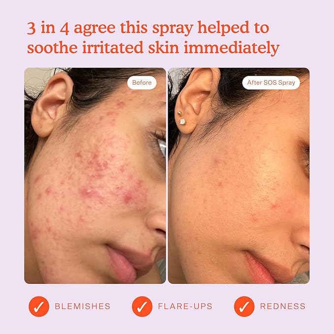 Tower 28 SOS Daily Rescue Facial Spray for Sensitive Skin, Hypochlorous Acid Spray Helps Visibly Reduce the Appearance of Redness and Breakouts, Travel Size Toner for Face, 1 FL Oz-GlimoraGlow