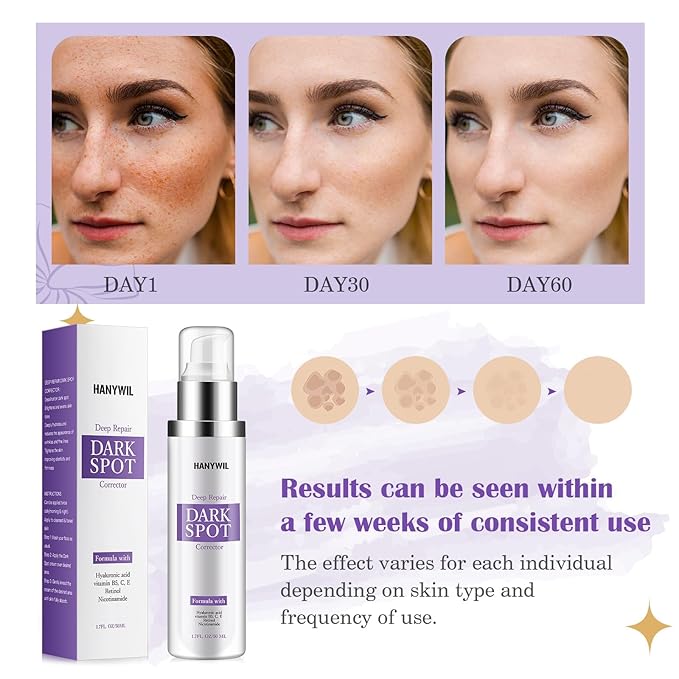HANYWIL Dark Spot Remover for Face & Body Serum,Rapid Tone Repair Cream with Hyperpigmentation Treatment,Sun Spot, Age Spot & Melasma Remover,Dermatologist-Tested Brightening Retinol Serum (1.7 Fl Oz)-GlimoraGlow