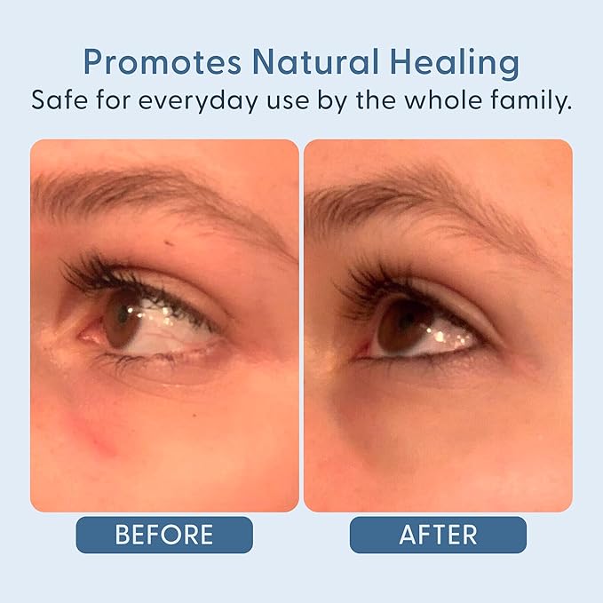 twenty/twenty Easy On The Eyes – 0.02% Hypochlorous Acid Spray to Cleanse Eyelashes – Reduce Eyelid Irritation – Safe for Sensitive Skin – Ophthalmologist Developed–Vegan, Clean Ingredients – 60ml-GlimoraGlow