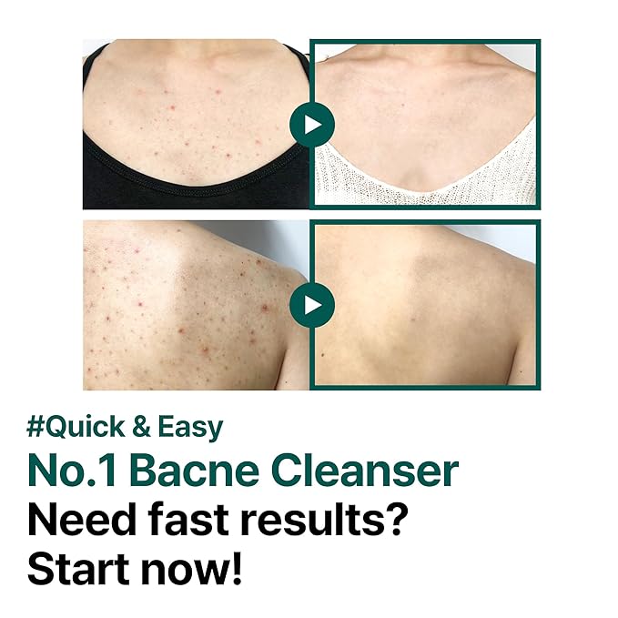 SOME BY MI AHA BHA PHA 30 Days Miracle Acne Clear Body Cleanser - Pack of 2 - Daily Exfoliating Tea Tree Acne Body Wash with Salicylic Acid - Deep Cleanses Sebum and Impurities - Korean Skin Care-GlimoraGlow